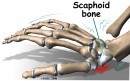 Scaphoid bone injury