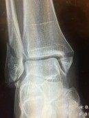 Troy Bayliss' fractured leg