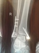 A fracture similar to that of Troy Bayliss