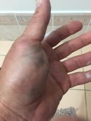 Troy Bayliss swollen hand