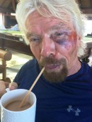 Richard Branson bicycle crash aftermath