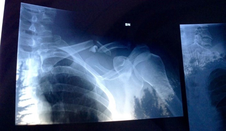 Alex Zanardi's Broken Collarbone