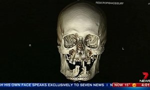 Australian Badass Drives Himself to Hospital After Chainsawing Half His Face
