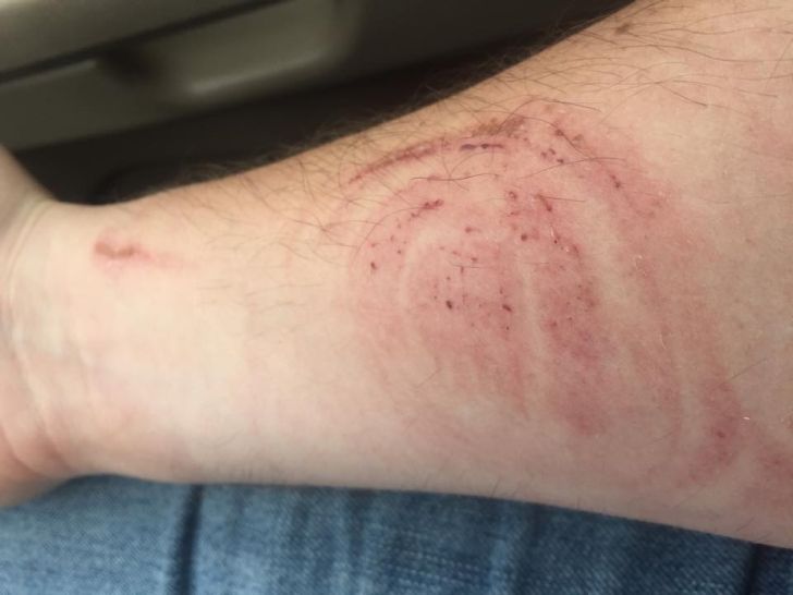 Cadillac "scar" on driver's forearm